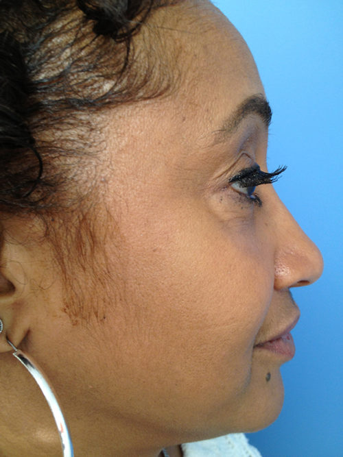 Eyelid Surgery