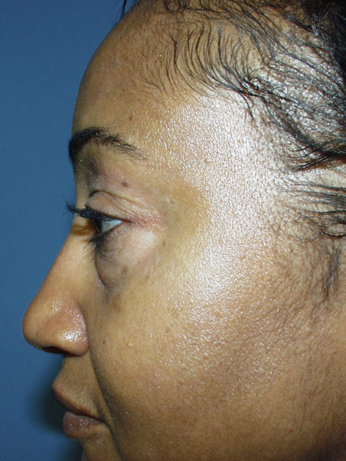 Eyelid Surgery Case 1004 Before Photo Eyelid Surgery