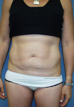 Tummy Tuck (Abdominoplasty)