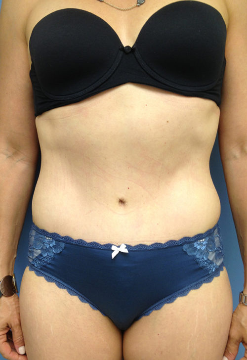 Tummy Tuck (Abdominoplasty) Case 1040 After Photo Tummy Tuck (Abdominoplasty)