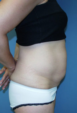 Tummy Tuck (Abdominoplasty)