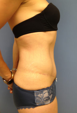 Tummy Tuck (Abdominoplasty)