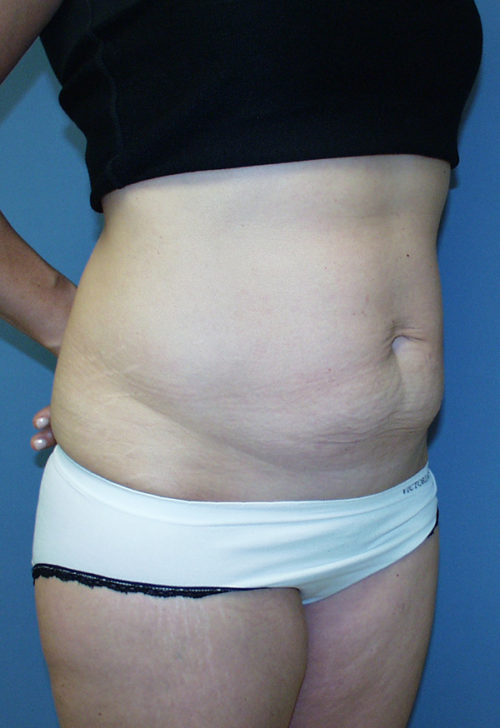 Tummy Tuck (Abdominoplasty)