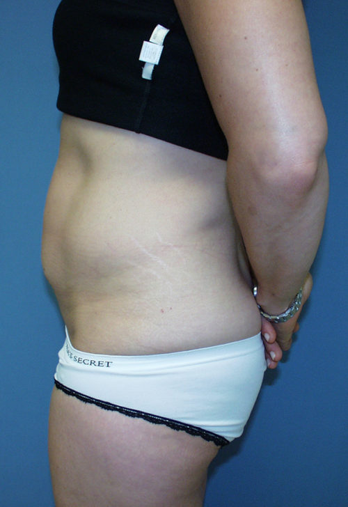 Tummy Tuck (Abdominoplasty)