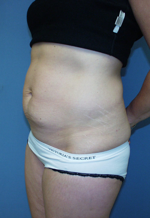 Tummy Tuck (Abdominoplasty)