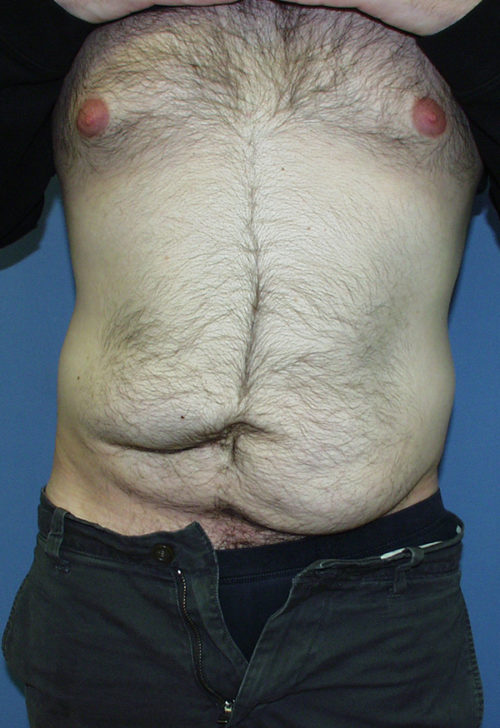 Male Abdominoplasty/Body Lift