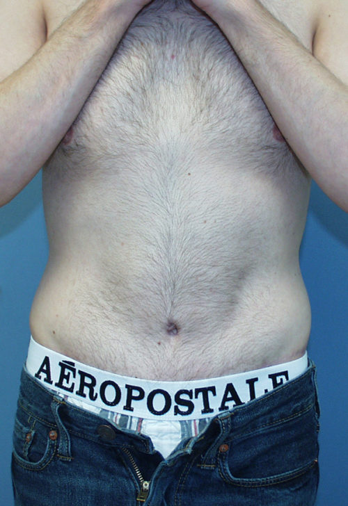 Male Abdominoplasty/Body Lift