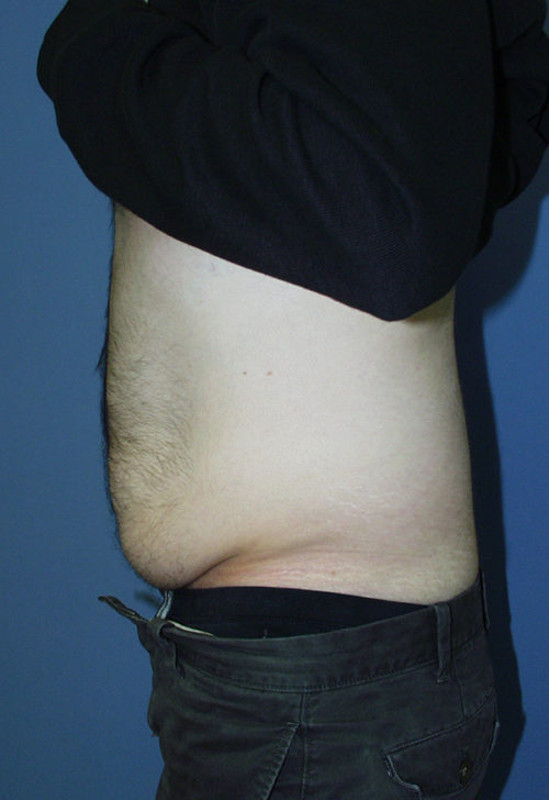 Male Abdominoplasty/Body Lift