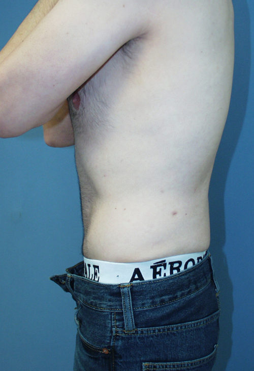 Male Abdominoplasty/Body Lift