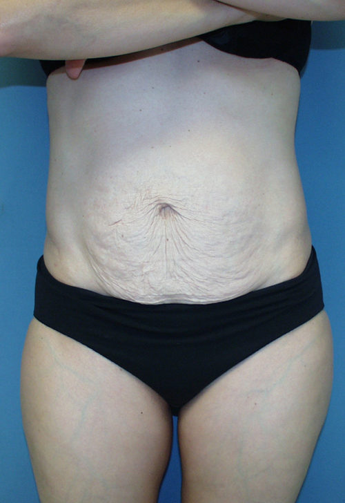 Tummy Tuck (Abdominoplasty)