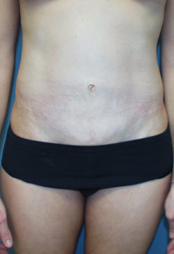 Tummy Tuck (Abdominoplasty)