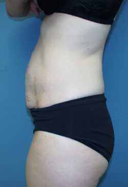 Tummy Tuck (Abdominoplasty)