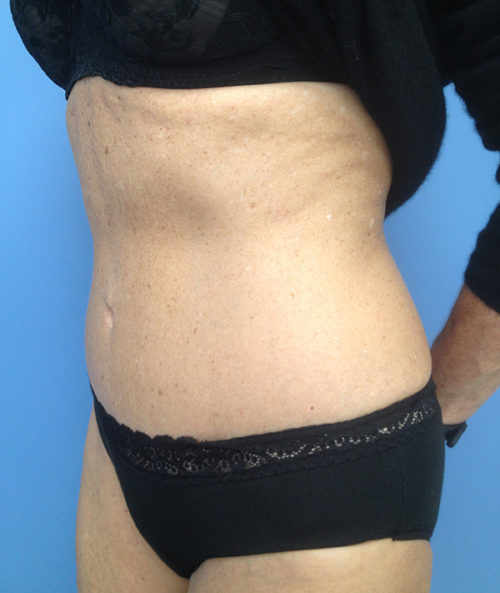 Tummy Tuck (Abdominoplasty)