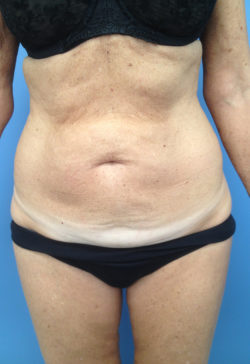 Tummy Tuck (Abdominoplasty)