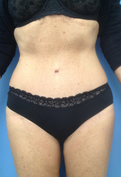 Tummy Tuck (Abdominoplasty)