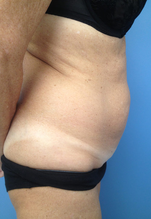 Tummy Tuck (Abdominoplasty)