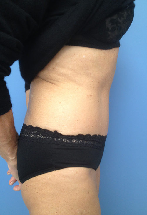 Tummy Tuck (Abdominoplasty) Case 1043 After Photo Tummy Tuck (Abdominoplasty)