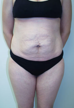 Tummy Tuck (Abdominoplasty)