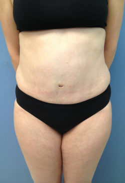 Tummy Tuck (Abdominoplasty)