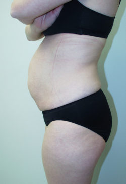 Tummy Tuck (Abdominoplasty)