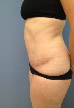 Tummy Tuck (Abdominoplasty)