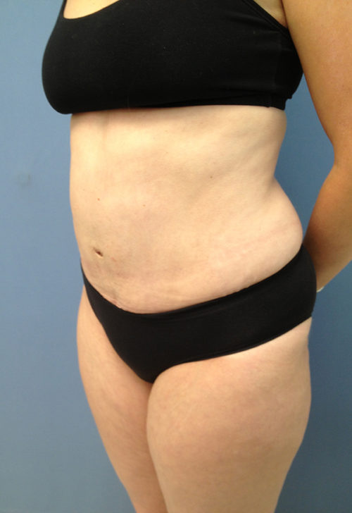 Tummy Tuck (Abdominoplasty)