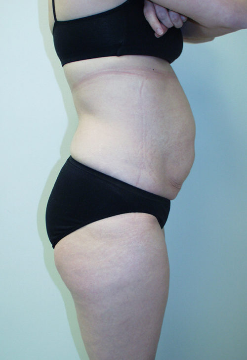 Tummy Tuck (Abdominoplasty)