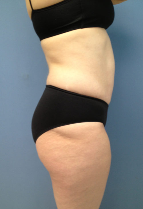 Tummy Tuck (Abdominoplasty)