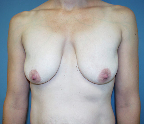 Breast Lift/Augmentation