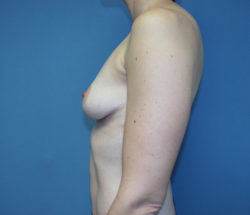 Breast Lift/Augmentation
