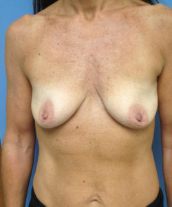 Breast Lift/Augmentation