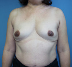 Breast Augmentation