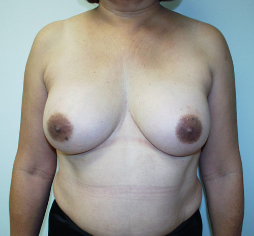 Breast Augmentation