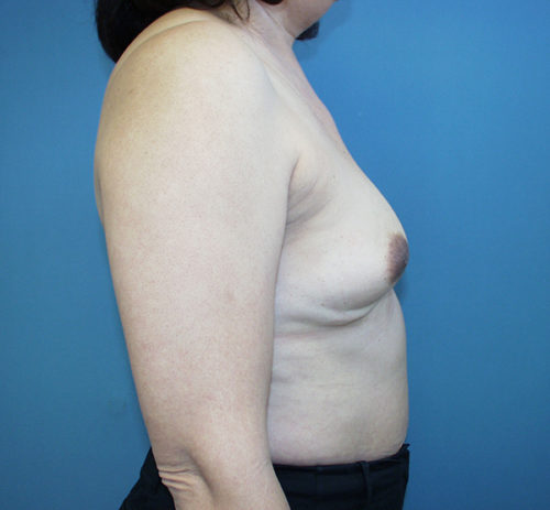 Breast Augmentation