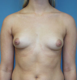 Breast Augmentation