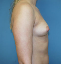 Breast Augmentation