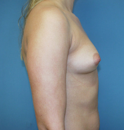 Breast Augmentation