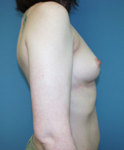 Breast Augmentation