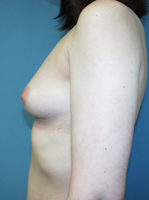 Breast Augmentation