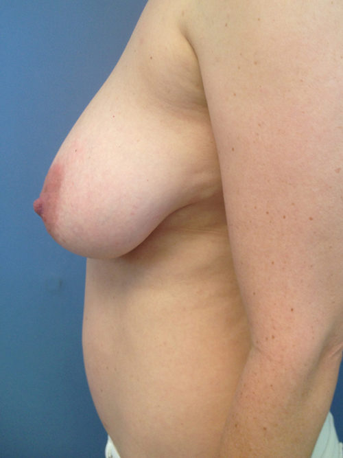 Breast Reduction Case 1124 Before Photo Breast Reduction