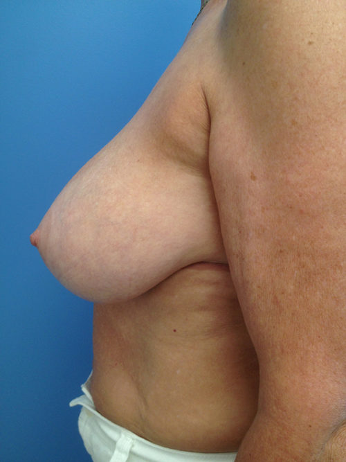 Breast Reduction Case 1126 Before Photo Breast Reduction
