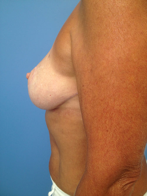 Breast Reduction Case 1126 After Photo Breast Reduction