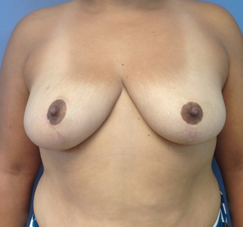 Breast Reduction Case 1127 After Photo Breast Reduction