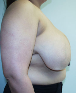 Breast Reduction