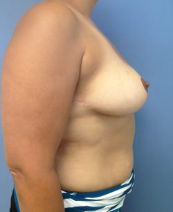 Breast Reduction