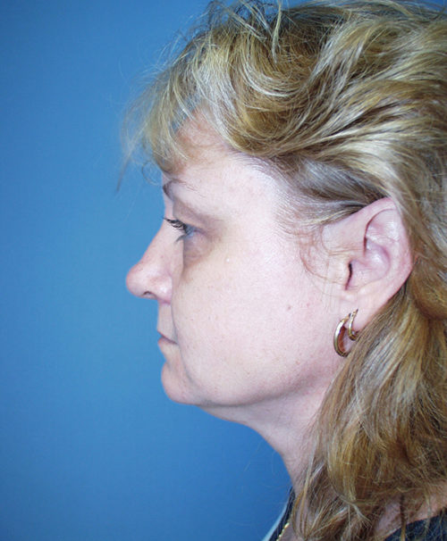 Chin Augmentation