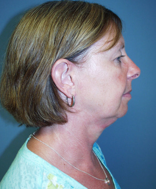 Chin Augmentation