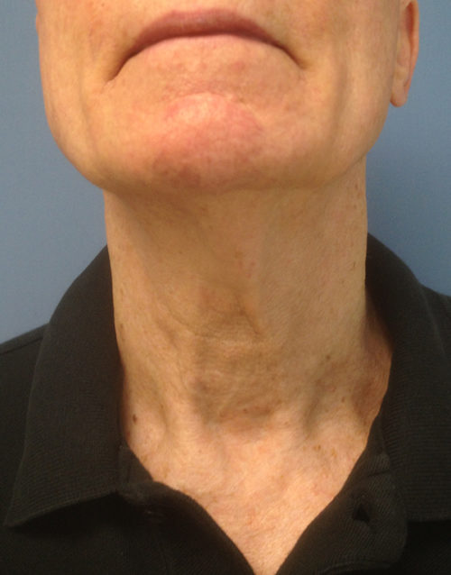 Direct Excision Neck Lift Case 1158 Before Photo Direct Excision Neck Lift