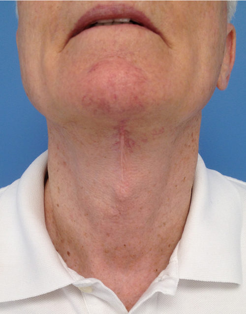 Direct Excision Neck Lift Case 1158 After Photo Direct Excision Neck Lift