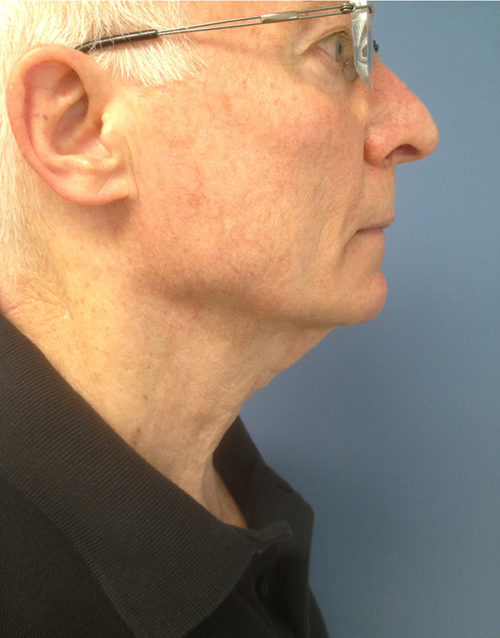 Direct Excision Neck Lift